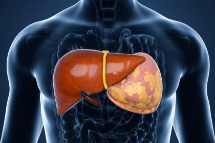 Ilustrasi hati berlemak dengan latar belakang tubuh manusia