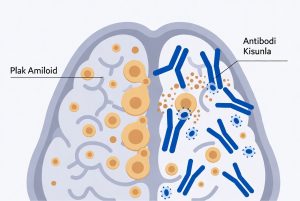 Ilustrasi Kisunla membersihkan plak amiloid di otak pasien Alzheimer