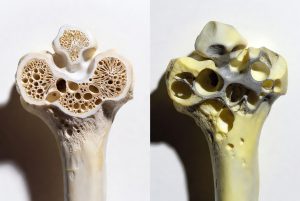 Perbandingan tulang sehat dan tulang keropos akibat osteoporosis